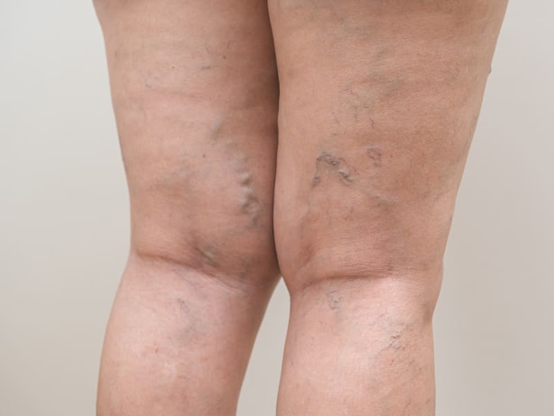 tratamiento pie diabetico